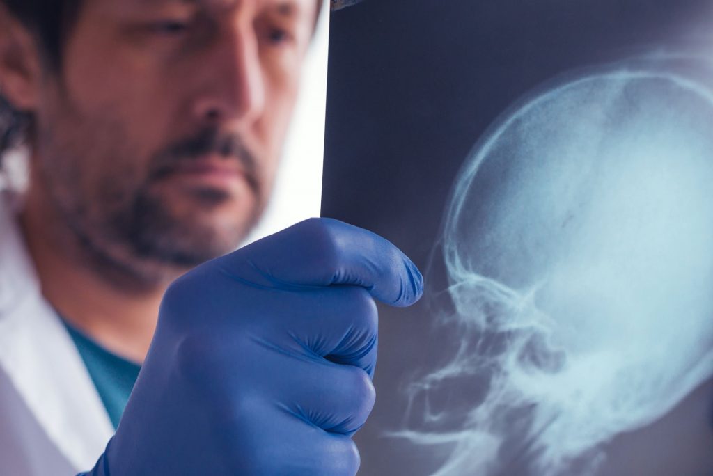 examining x-ray of skull - brain/head injury claim compensation Leeds